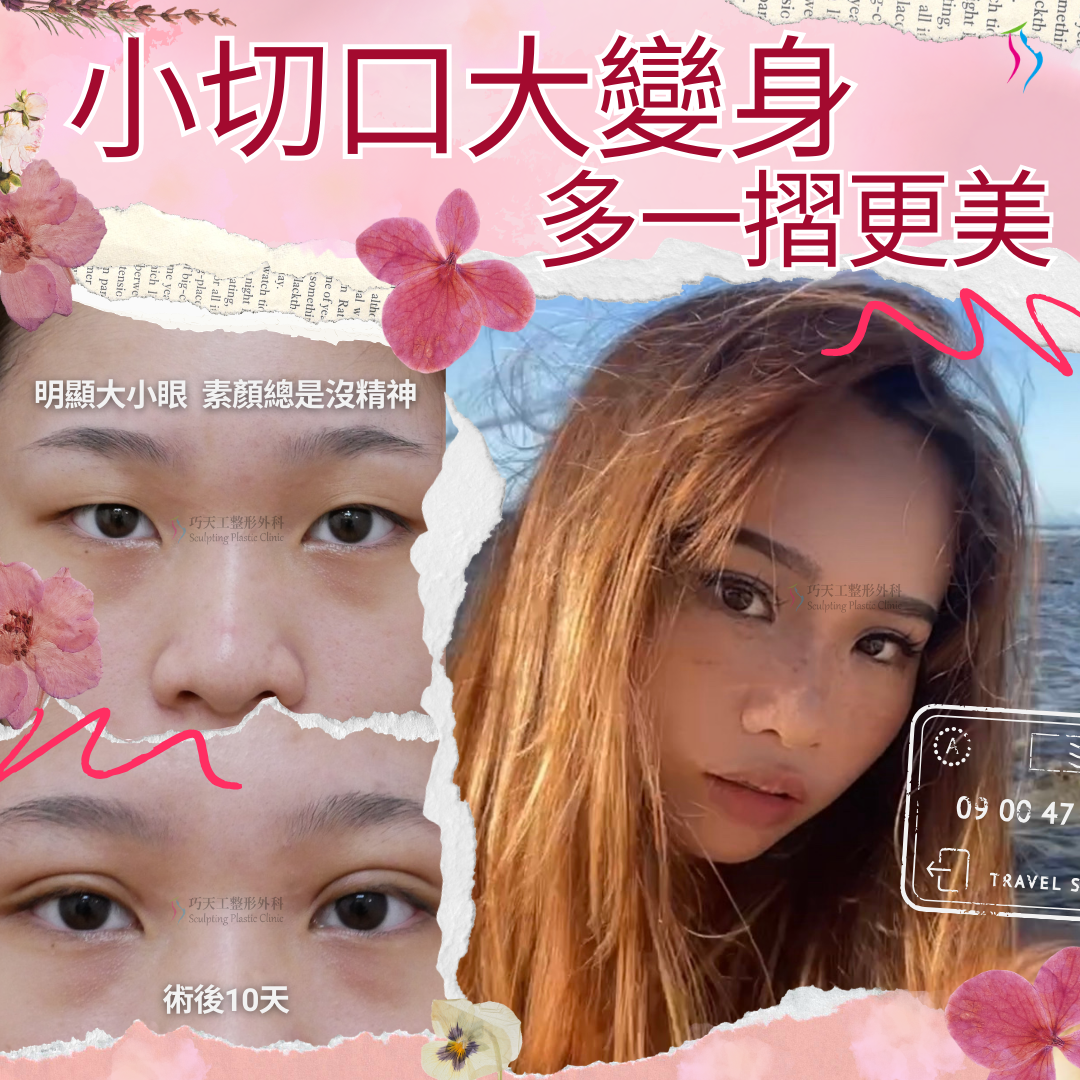 【雙眼皮】《陳善運》『微創小切口』大變身 多一摺更好看